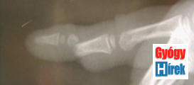 Kutyaharapás a kisujjon röntgen