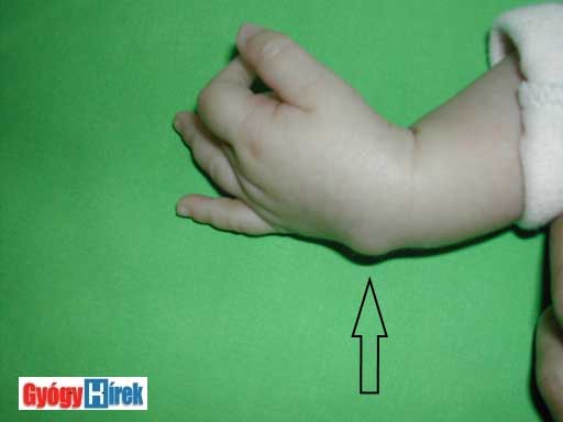 artrózisos zselatin kezelési recept könyökízület középső ujj fájdalma