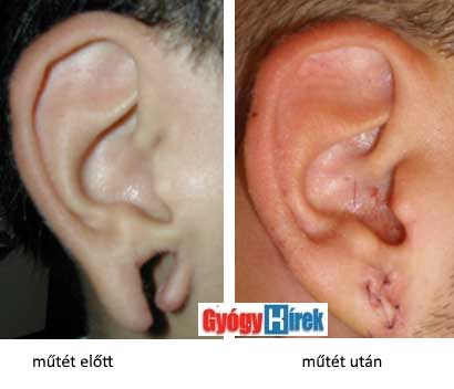 fül korrekció