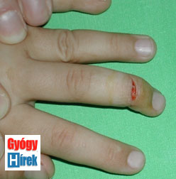 Gyógyító sebek az ujjak között