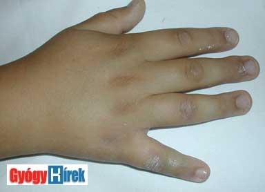 középső ujj sérülése