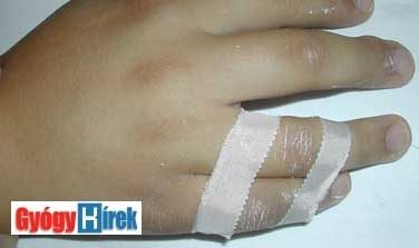 Zárt kéz ujjperc sérülések ⋆ Gyógyhírek