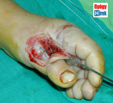 A feszítőín sérülések ellátása a kézen