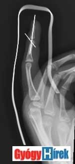 gyűrűs ujj sérülése poszt traumás artrosis ankylosis a jobb vállízületben