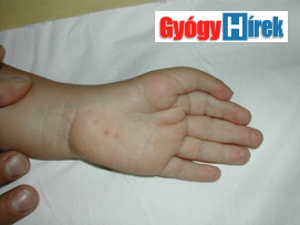gyógyító sebek az ujjak között papillomavírus ember ellátása