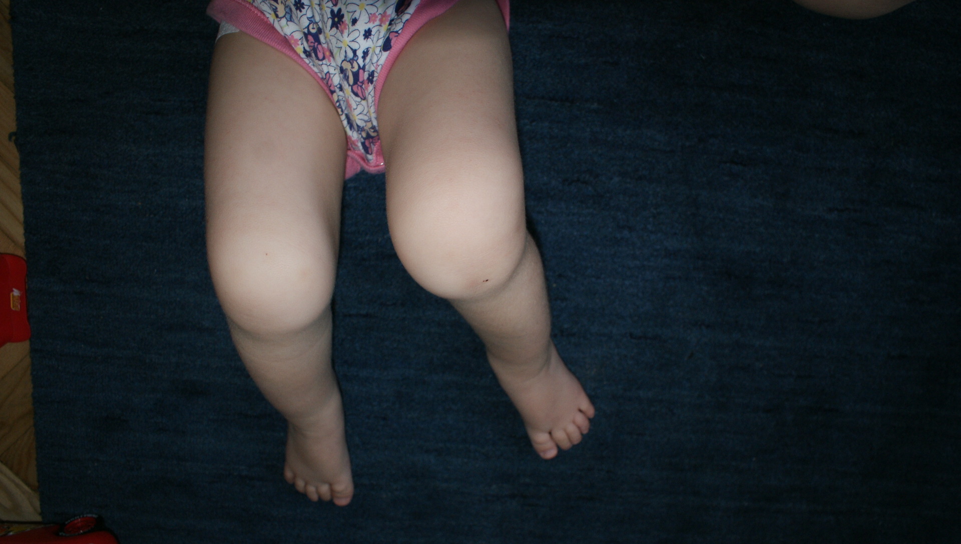 Csípő-, térd- és lábproblémák gyermekkorban - CardioBaby, Gyermek 4 éves térdfájdalma