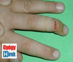 Apróság, de mégis komoly: fedett ínszakadás a kéz ujjain - Gyűrűs ujj sérülése