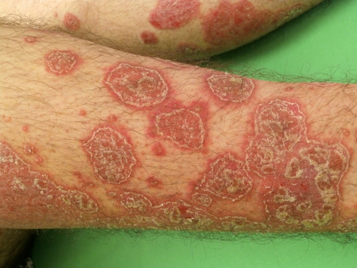 Fejlett pikkelysömör kezelsi mdszerek, Eucerin®: A bőrről | Psoriasis - tünetek, okok és megoldások