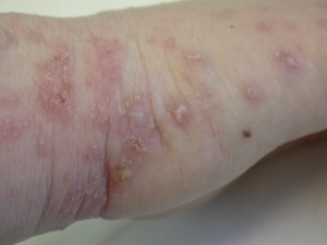 fertőző bőrbetegségek miért jelent meg egy piros folt a lábán