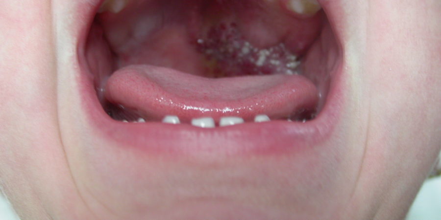 vörös foltok a szájban okok és kezelés fotó