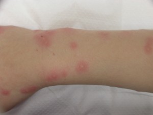 Rovarok és élősködők okozta bőrbetegségek Parazita az emberi bőr kezelése során