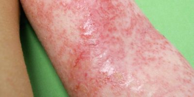 bőrbetegségek paraziták