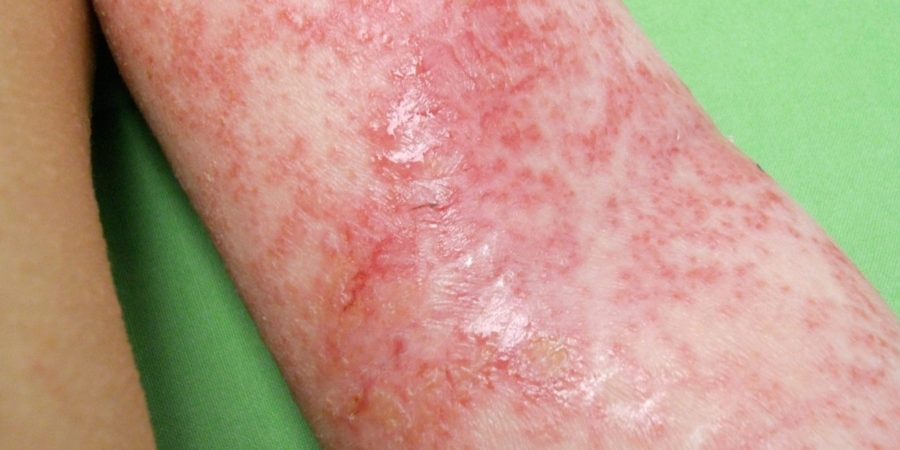 atopias dermatitisz lelki okai szőrös pikkelysömör és gyógyszerek