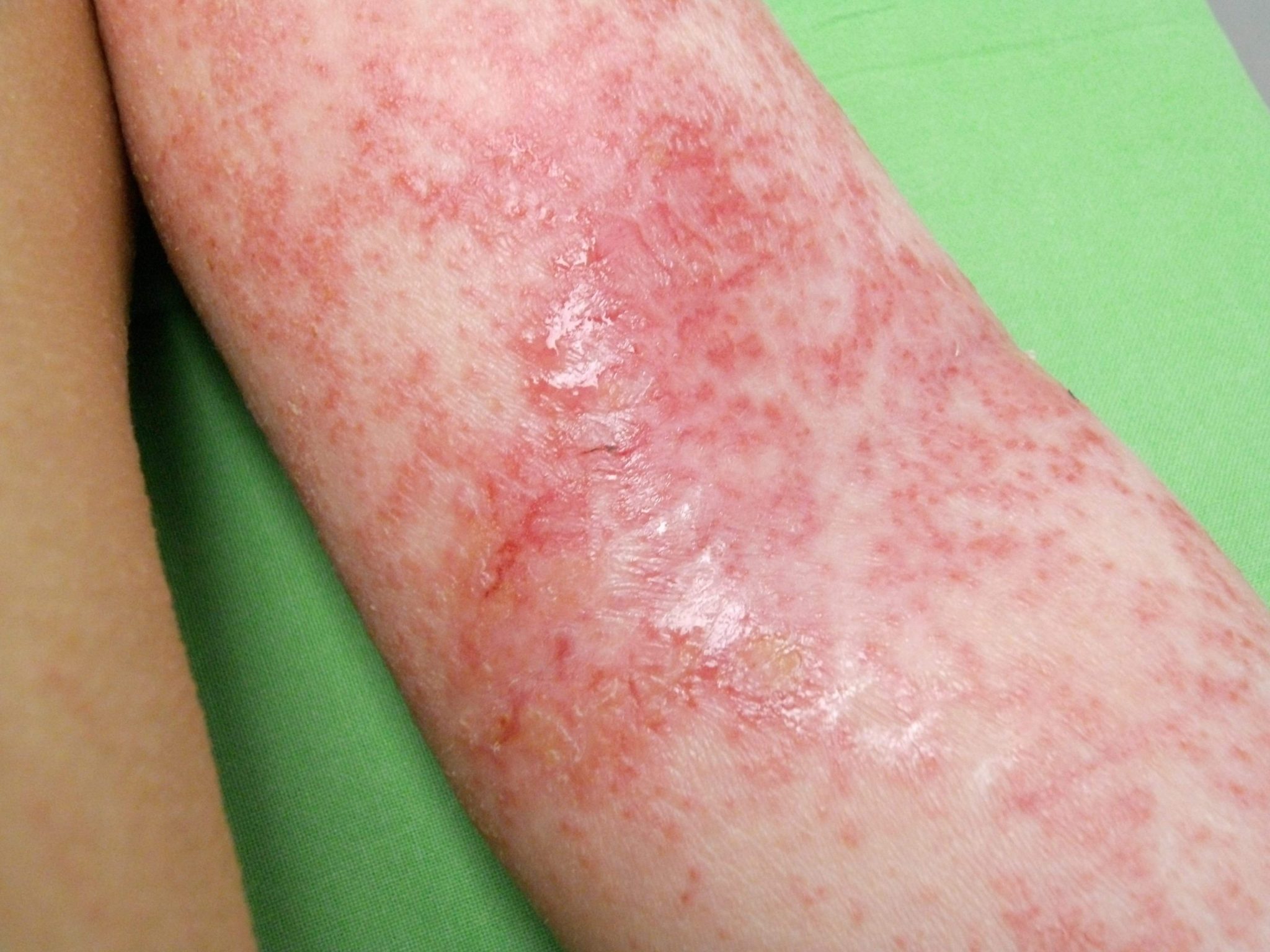 újszülött atópiás dermatitis)