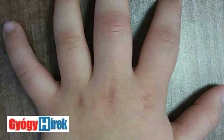 A kéz gennyesedései (panaritiumok) tünetei és kezelése | Házipatika
