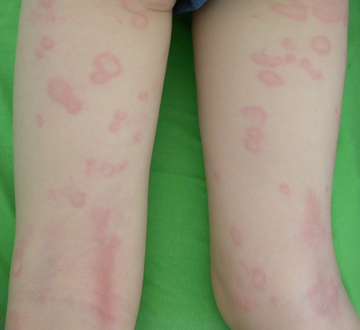 3 gyakori bőrbetegség, aminek lelki oka is lehet - Gyerek | Femina