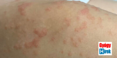 Rovarok és élősködők okozta bőrbetegségek Parazita az emberi bőr kezelése során