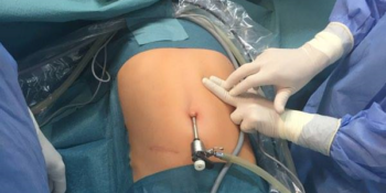 epekövesség miatti laparoszkópos műtét