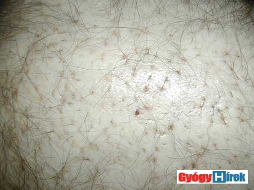 a kis hegekben behelyezett haj transzplantátumok láthatók