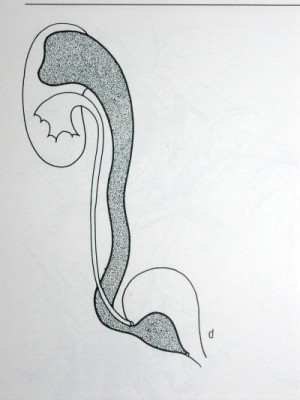 Kettős üregrendszerű veséhez társuló ureterocele sémás rajza. 