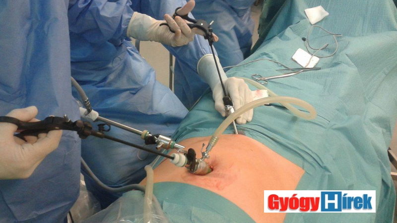 laparoscopos műtét 1. ábra