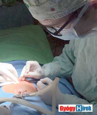 lágyéksérv laparoscopos műtéte