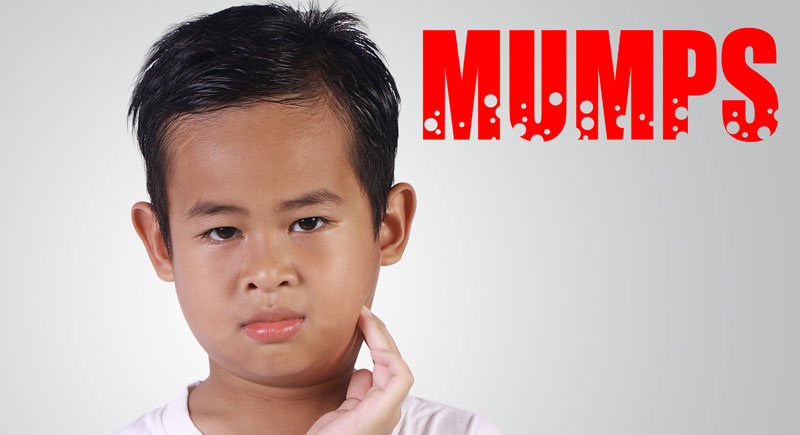 mumpsz parotitis epidemica