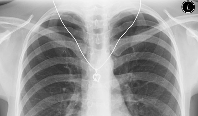 aszcariasis röntgen a tüdőben)