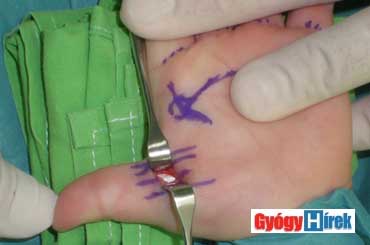 pattanó ujj műtét után