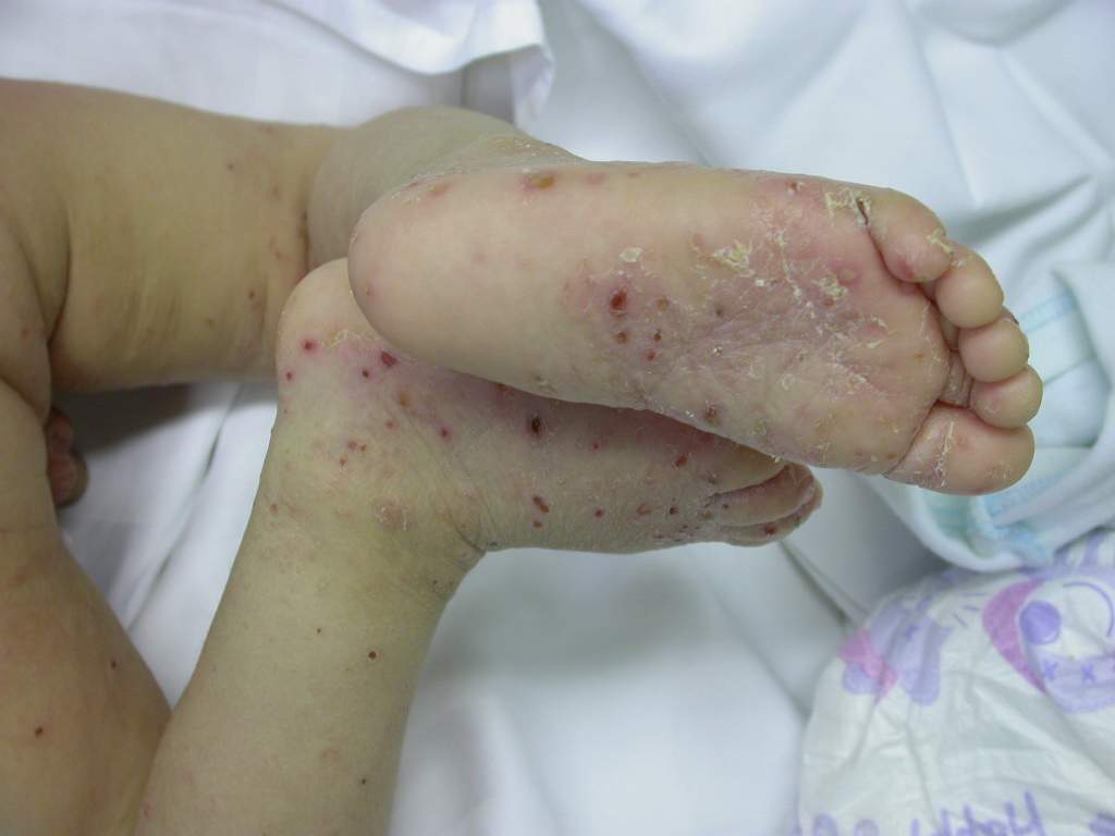 kerek rüh kezelésének folyamata hogyan lehet gyógyítani a gyermekek helminthiasisát