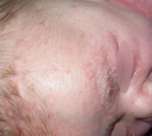 koszmó - seborrhoeas dermatitis 