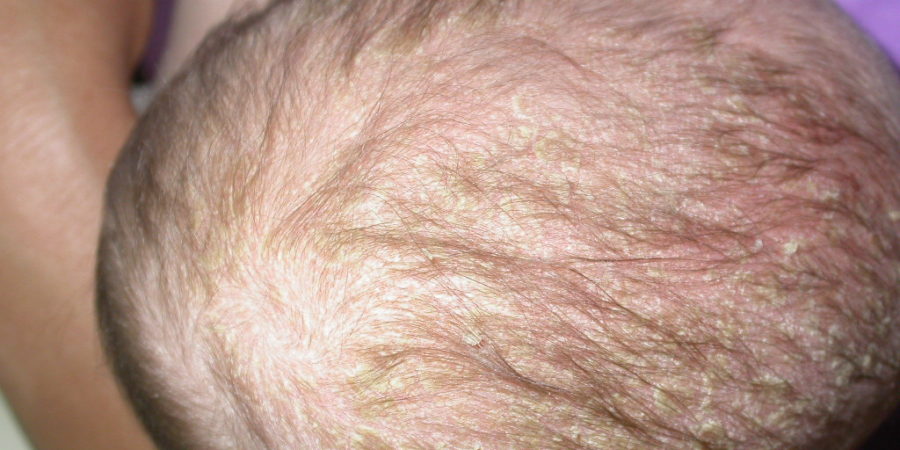 vörös pikkelyes foltok a fejbőr hajában phyto psoriasis kezelése