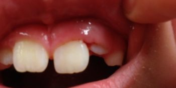 vírusos szájnyálkahártya gyulladás