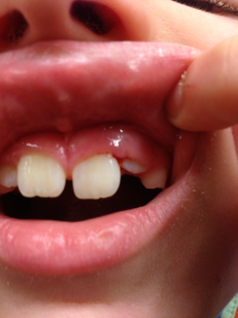 hólyag a szájban nem fáj jóindulatú prosztata megnagyobbodás gyógyszeres kezelése