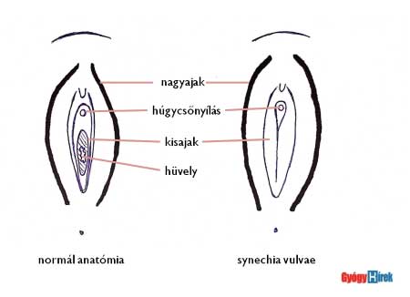 Női anatómia: A szeméremajkak típusai