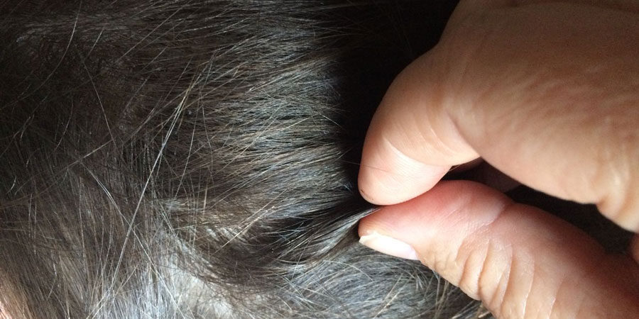Bőrgombásodás tünetei és kezelése Vörös foltok a fejbőrön a haj fotó alatt
