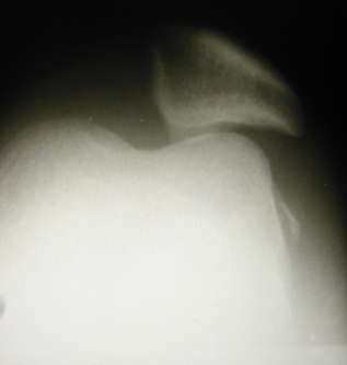 2.ábra térdkalács ficam helyretétel utáni rtg képe a kifelé forduló térdkaláccsal és az oldalt látható kitört porcos-csontos darabbal.