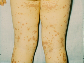 élénkpiros foltok jelentek meg a lábakon az arc bőrét vörös foltok borítják